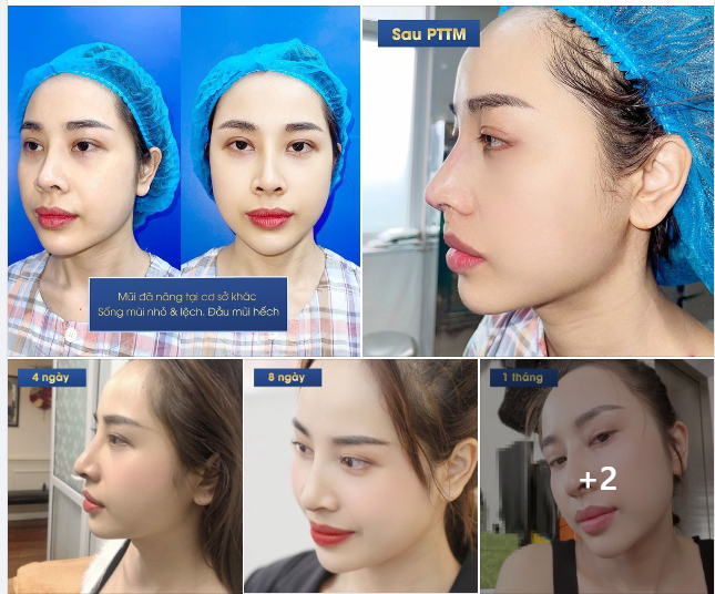 HÀNH TRÌNH TỪ MŨI LỆCH, HẾCH THÀNH MŨI CAO TỰ NHIÊN, ĐẸP ƯNG Ý CỦA LÊ HỒNG