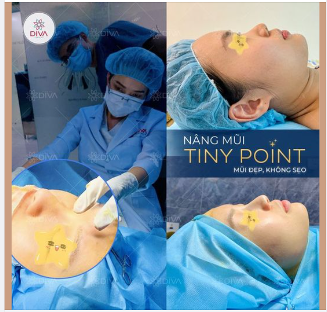 NÂNG MŨI TINY POINT - MŨI ĐẸP KHÔNG SẸO SAU THỰC HIỆN