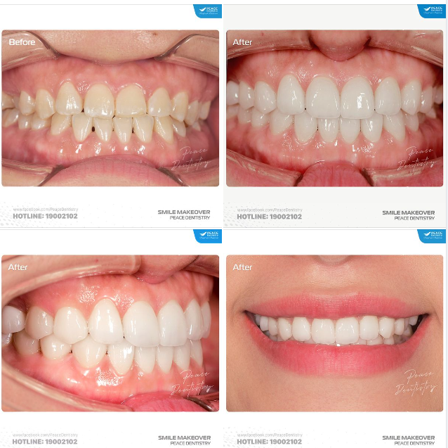 CA VENEER VÙNG RĂNG TRƯỚC GIỮ LẠI GẦN NHƯ TRỌN VẸN RĂNG TỰ NHIÊN