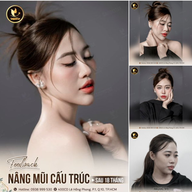 NHAN SẮC RẠNG RỠ CỦA HOT TIKTOKER HOÀNG OANH SAU 18 THÁNG NÂNG MŨI CẤU TRÚC!