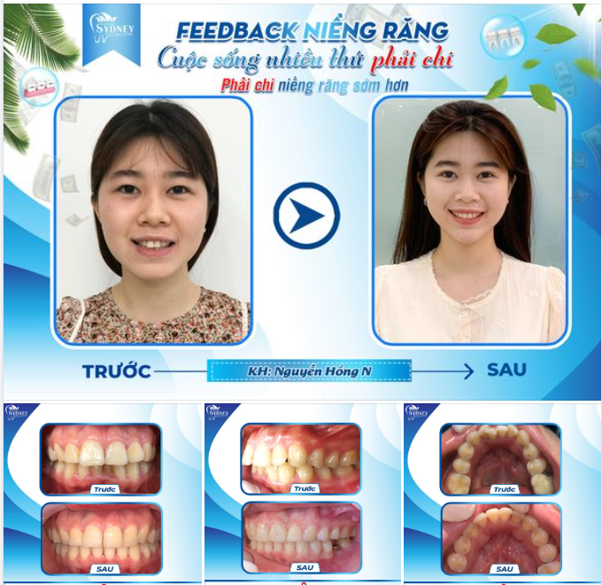 CUỘC SỐNG NHIỀU THỨ PHẢI CHI - PHẢI CHI NIỀNG RĂNG SỚM HƠN