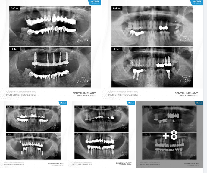 TRƯỚC & SAU KHI CẤY GHÉP IMPLANT TRÊN FILM PANOREX: