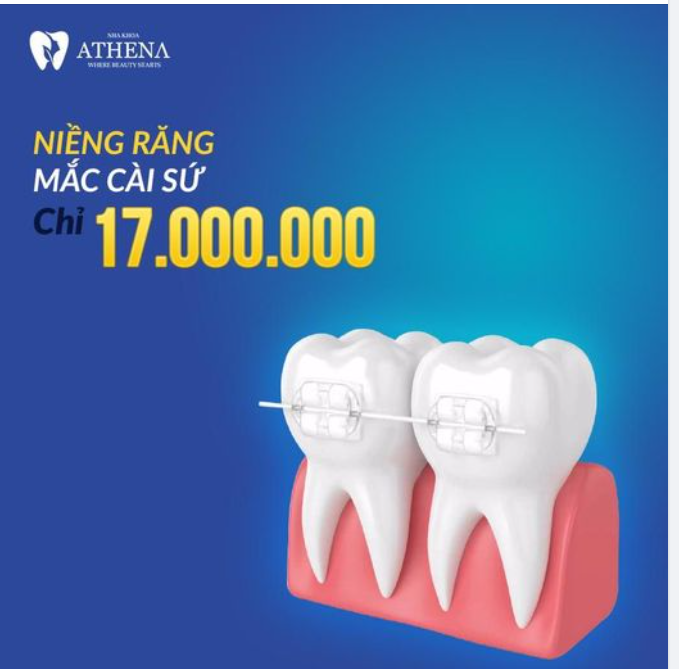 NIỀNG RĂNG MẮC CÀI SỨ CHỈ TỪ 17.000.000