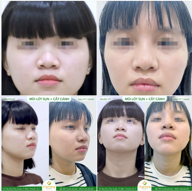 Mới chỉ phẫu thuật được 7 ngày và vùng mũi còn bị sưng nhưng Charming vẫn thấy được kết quả tuyệt vời của phẫu thuật nâng mũi lót sụn kết hợp cắt cánh mũi đối với nàng khách.