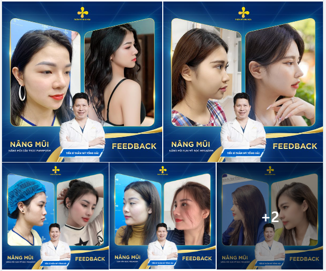 Những bức ảnh bên dưới chính là lý do nâng mũi luôn nằm trong top những dịch vụ phẫu thuật thẩm mỹ được yêu thích nhất.
