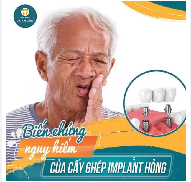 Trồng răng Implant đang trở thành giải pháp hoàn hảo giúp tình trạng mất răng, rụng răng tìm lại nụ cười hoàn hảo.
