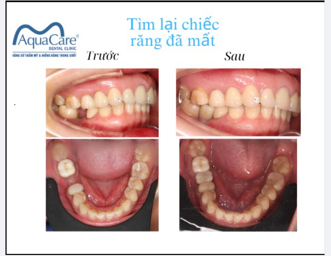LẤY LẠI CẢM GIÁC ĂN NHAI TRỌN VẸN