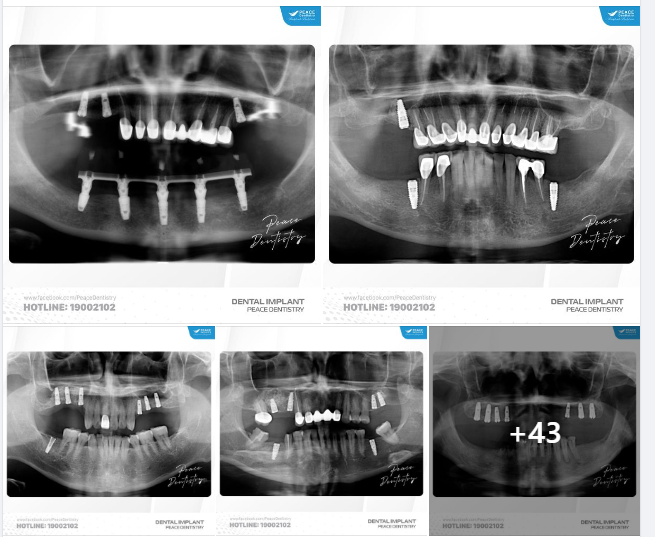 IMPLANT GALLERY 05/2024 - Peace Dentistry