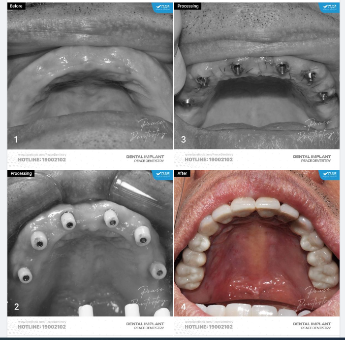 Ca lâm sàng all-on-6 implant hàm trên giúp khôi phục trọn vẹn chức năng ăn nhai và cải thiện thẩm mỹ nụ cười cho Chú khách hàng lớn tuổi đã đeo hàm tháo lắp hơn 10 năm.