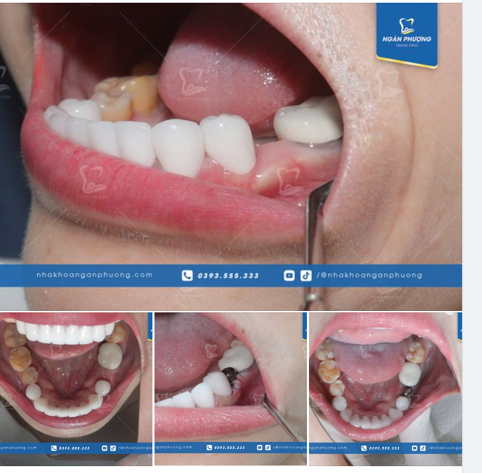Phục hình răng 35 cho chị Nguyễn Thư.