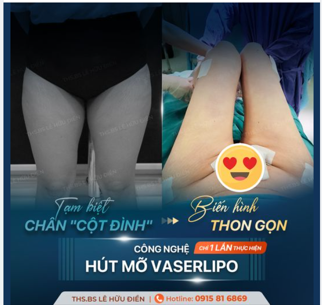 Tạm biệt chân cột đình - biến hình thon gọn