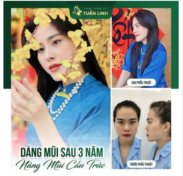 Nâng mũi cấu trúc sau 3 năm. Hình ảnh chiếc mũi xinh xắn 3 năm tuổi sau khi nâng tại Tuấn Linh.