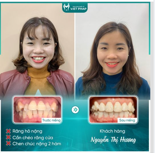 NỤ CƯỜI HOÀN HẢO VỚI NIỀNG RĂNG INVISALIGN