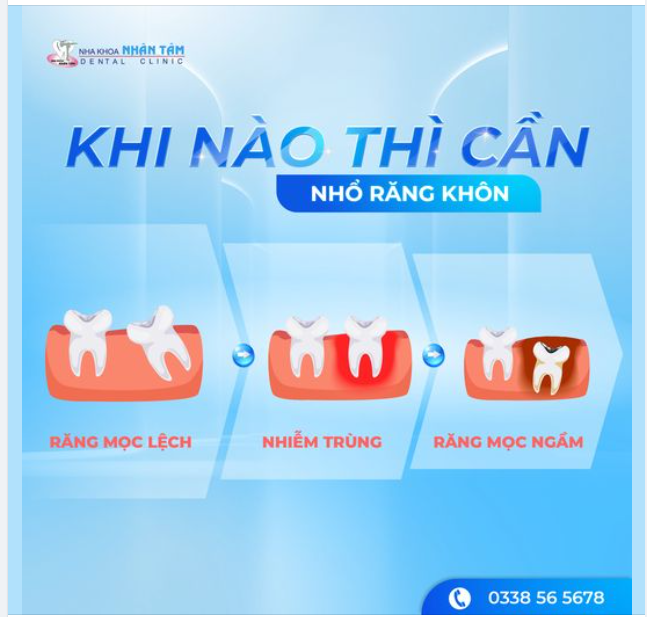 KHI NÀO THÌ CẦN NHỔ RĂNG KHÔN?