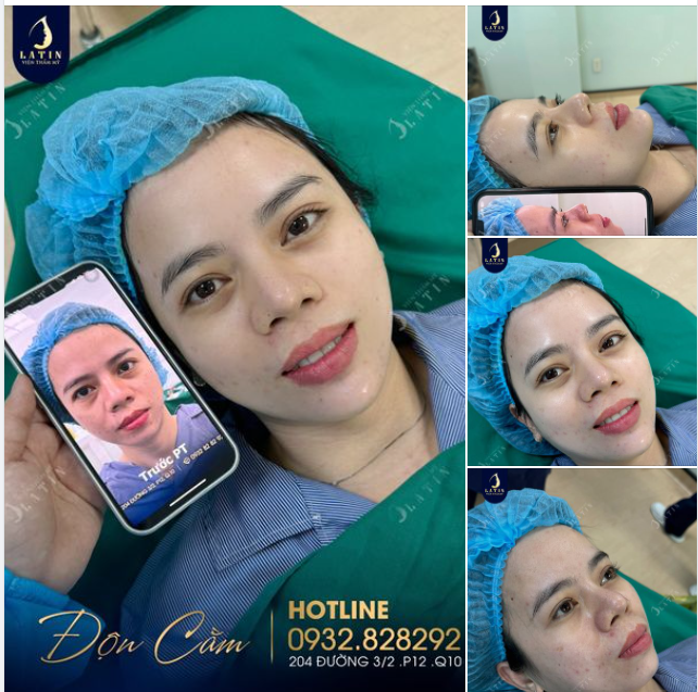 Nghe bảo cằm lẹm phong thủy không tốt, em gái nghe lời người thân đi độn cằm và cái kết
