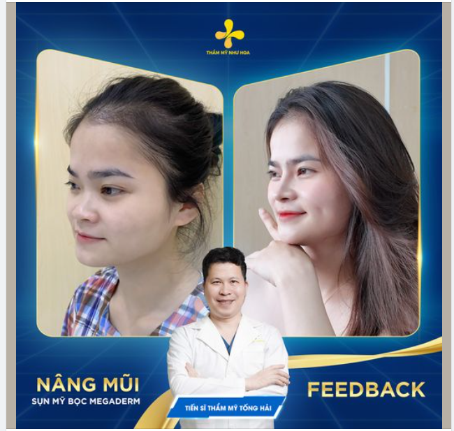Kết quả sau hơn 1 năm nâng mũi của cô chủ shop thời trang HUYỀN THẢO BOutique