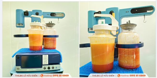 Điểm khác biệt của công nghệ Hút mỡ Vaserlipo chính là lượng mỡ hút ra vàng óng, không pha lẫn dịch và