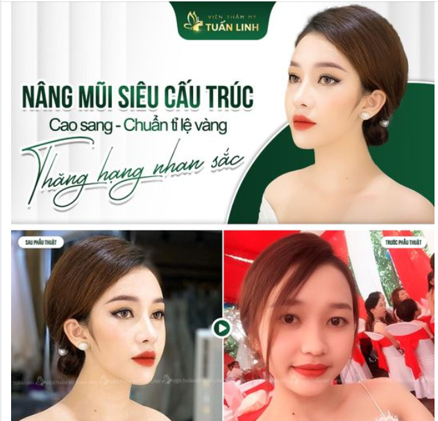 Nâng mũi siêu cấu trúc -> Sở hữu ngay dáng mũi " cực phẩm"!!