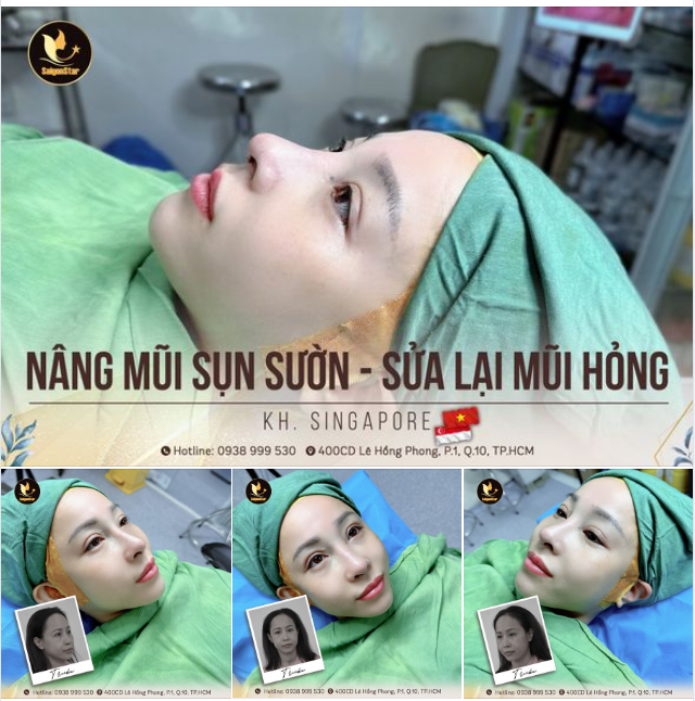 KẾT QUẢ: NÂNG MŨI CẤU TRÚC SỤN SƯỜN - GIÚP CHỊ KHÁCH SINGAPORE KHẮC PHỤC MŨI HỎNG
