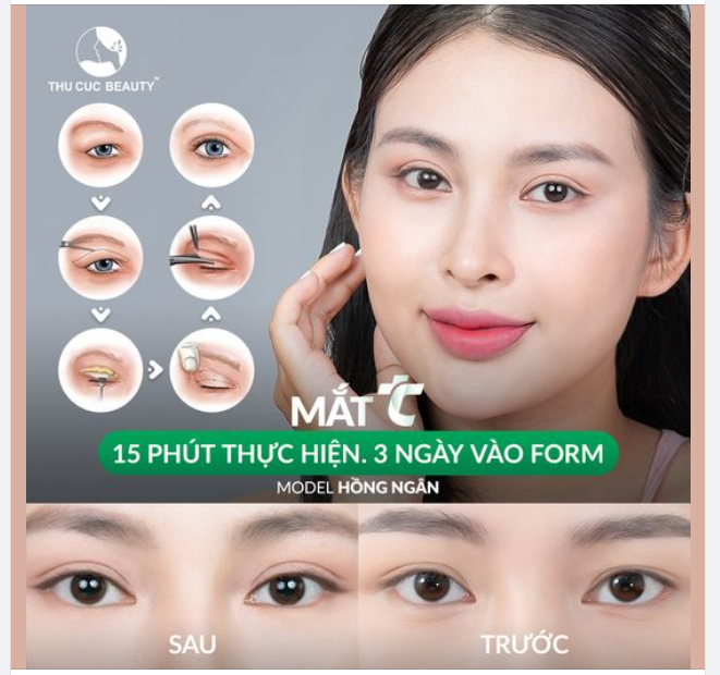 Nâng hạng nhan sắc "Siêu thần thái" nhờ cắt mí TC