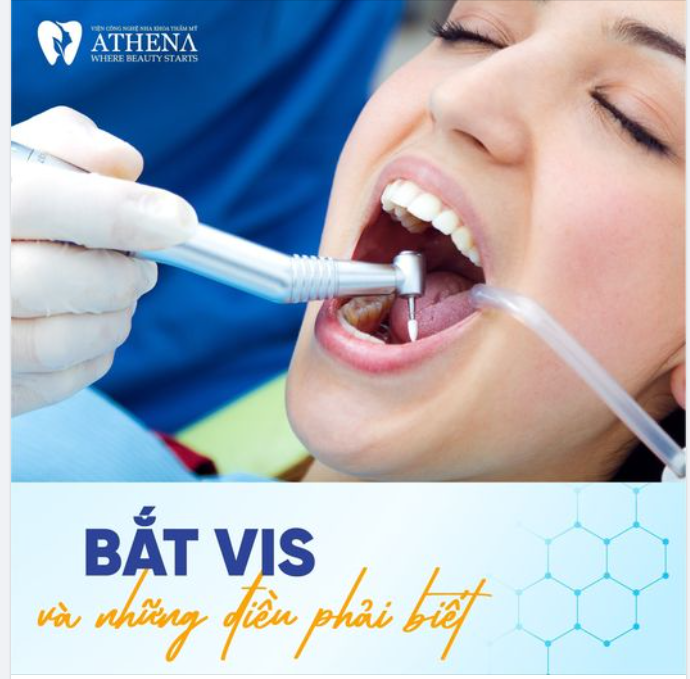 BẮT VIS VÀ NHỮNG ĐIỀU PHẢI BIẾT!