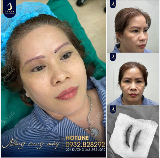 Nâng cung mày đa tầng cho cô khách đến từ Bạc Liêu