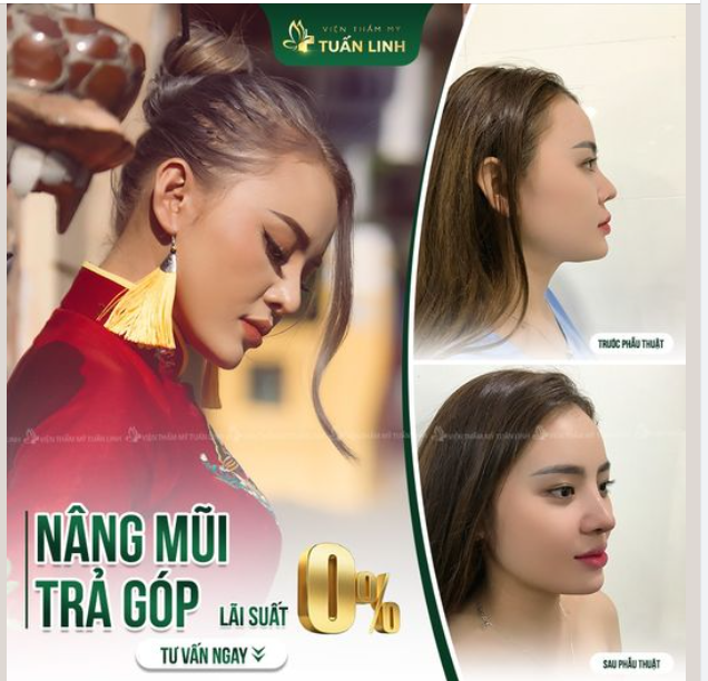 CHI PHÍ NÂNG MŨI CHỈ LÀ "CHUYỆN NHỎ"