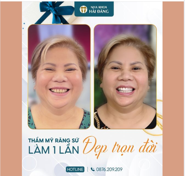 Cô Minh lặn lội từ Canada về Việt Nam và chọn nha khoa Hải Đăng để tân trang lại “nhan sắc hàm răng” cho mình và cái kết quá hài lòng!