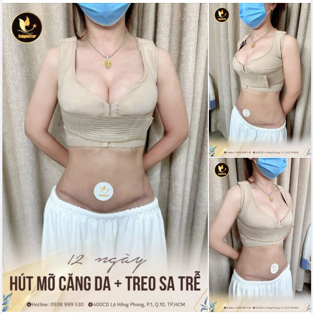 TÁI KHÁM HÚT MỠ CĂNG DA + TREO SA TRỄ  EO THON NGỰC TRÒN SAU 12 NGÀY
