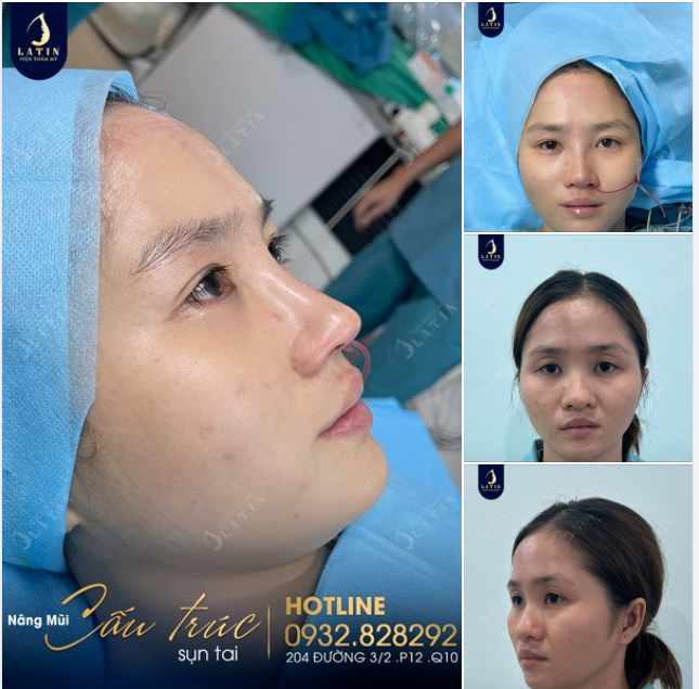 Hoàn thành ca mũi bán cấu trúc cho em gái đến từ An Giang