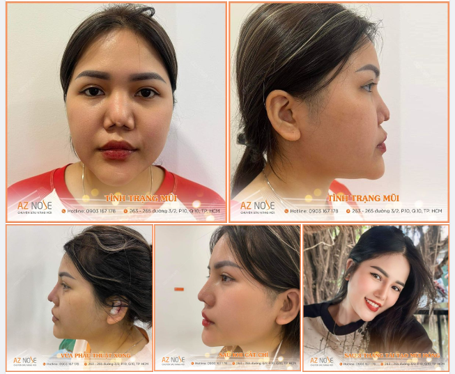 Quá khác biệt: Thay đổi đến 80% với dáng mũi mới!!