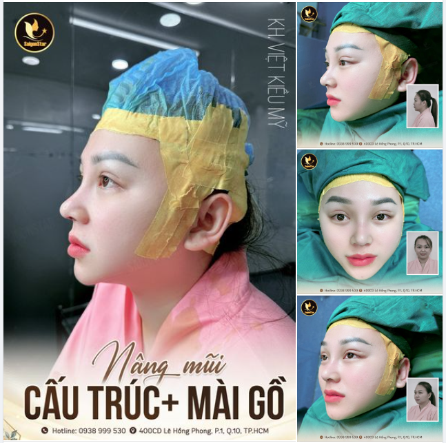 SAU 60 PHÚT NÂNG MŨI + MÀI GỒ - THAY ĐỔI 360 ĐỘ TỪ DIỆN MẠO ĐẾN PHONG THỦY