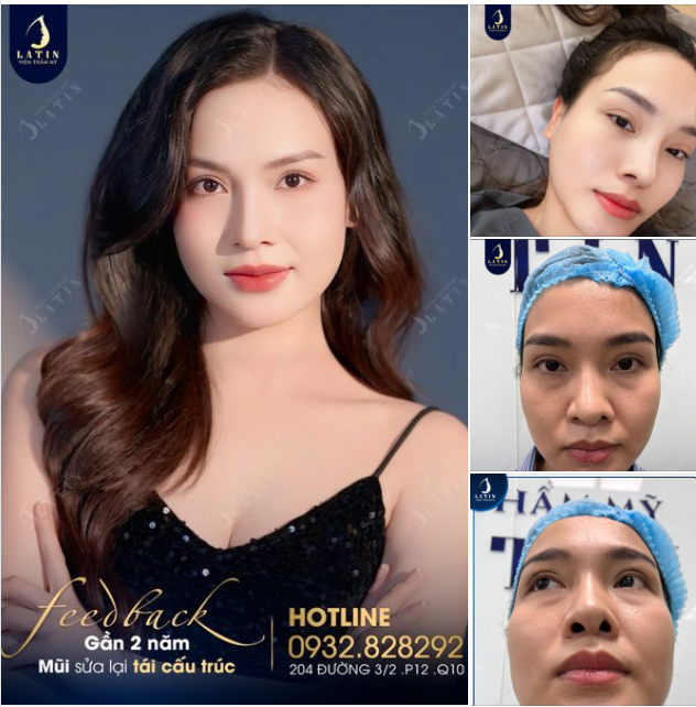 Cập nhật tình hình mũi sửa lại siêu ưng ý cho em gái sau gần 2 năm.