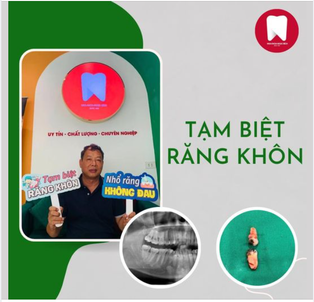NHỔ RĂNG KHÔN NHẸ NHÀNG - KHÔNG ĐAU - MAU LÀNH