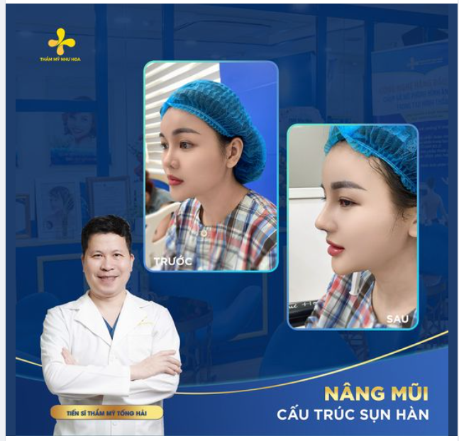Kết quả ngay sau ca mũi sửa cho bạn Thủy sinh năm 2004.