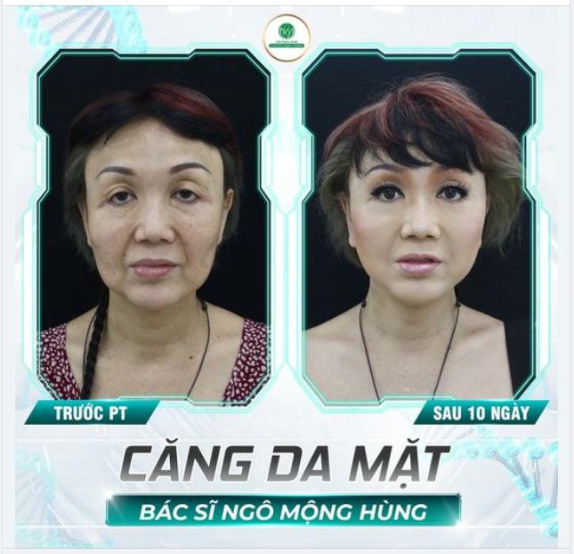 NHỮNG VÙNG DA DỄ LÃO HÓA NHẤT TRÊN MẶT