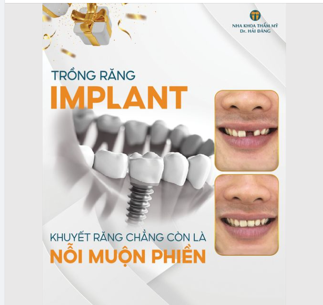 Chắc hẳn cảm giác ăn nhai khó chịu, đau buốt cả tháng trời, tự ti trong giao tiếp hàng ngày khi hàm răng bị khuyết 1 hoặc nhiều chiếc răng là điều bất cứ ai trải qua rồi cũng thấy cực kỳ khủng khiếp!