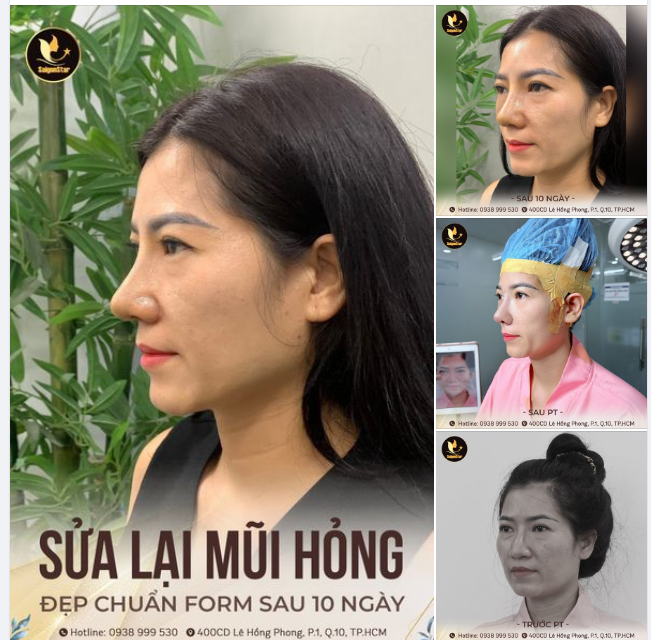 KẾT QUẢ SAU 10 NGÀY SỬA LẠI MŨI HỎNG BẰNG PHƯƠNG PHÁP NÂNG MŨI CẤU TRÚC