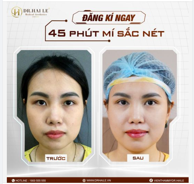 Tưởng gì khó, muốn sở hữu đôi mắt đẹp thì cứ để Dr.Hải Lê lo!