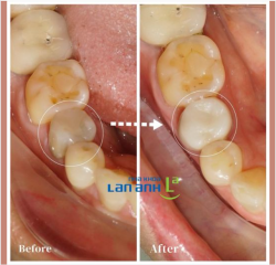 Răng đã được lấy tủy theo thời gian sẽ có những dấu hiệu sau: