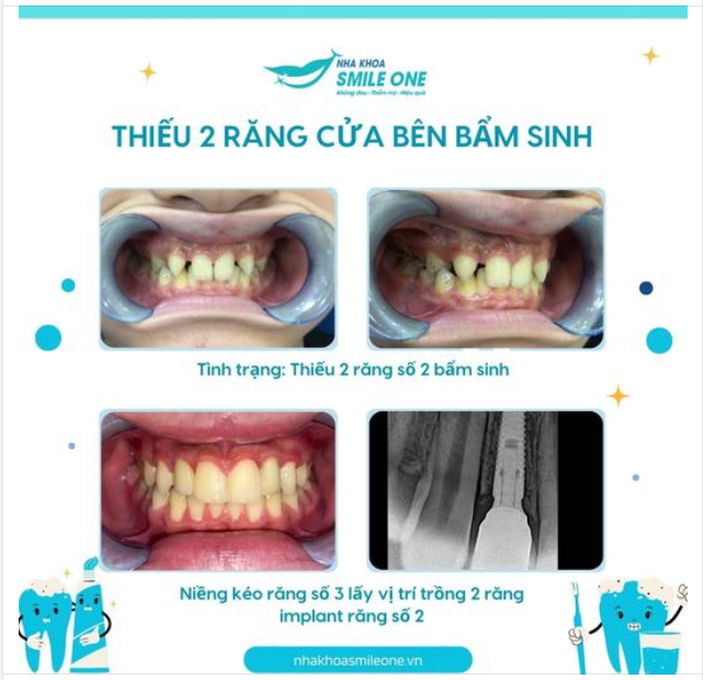 Thiếu răng bẩm sinh, bạn đã nghe nói chưa?