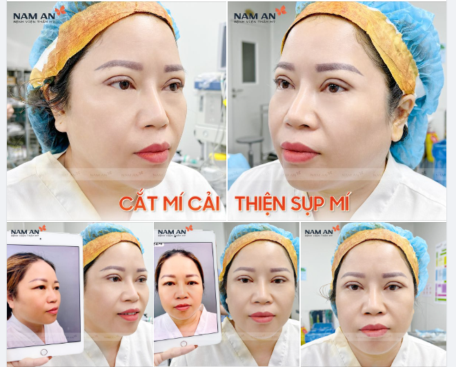 CẮT MÍ CẢI THIỆN SỤP MÍ
