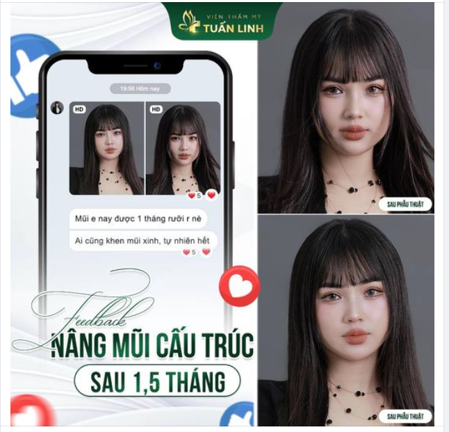 Feedback mũi cấu trúc sau 1,5 tháng của bạn khách hàng xinh đẹp nhà Tuấn Linh!!