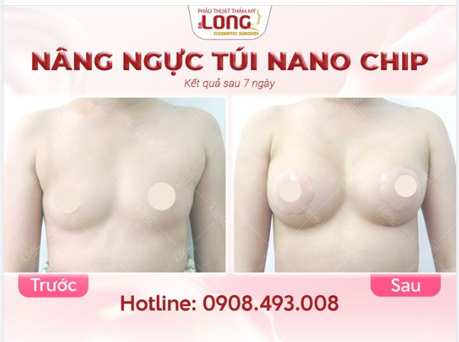 NÂNG NGỰC ÍT XÂM LẤN và những lợi ích khi thực hiện.