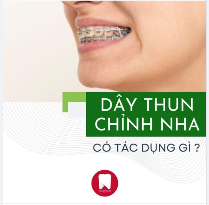 DÂY THUN CHỈNH NHA CÓ TÁC DỤNG GÌ