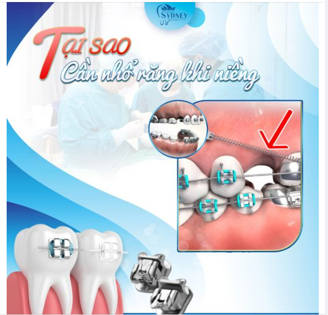 TẠI SAO PHẢI NHỔ RĂNG TRƯỚC KHI NIỀNG?