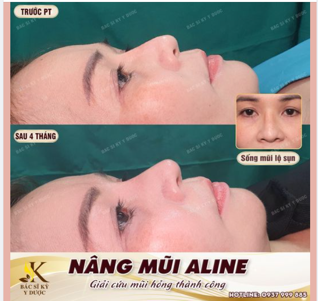 NÂNG MŨI ALINE - NÂNG CẤP HOÀN TOÀN KHUÔN MẶT