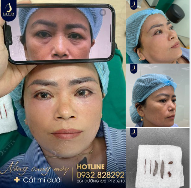 Combo trẻ hóa cho đôi mắt: Nâng cung mày - Cắt mí dưới