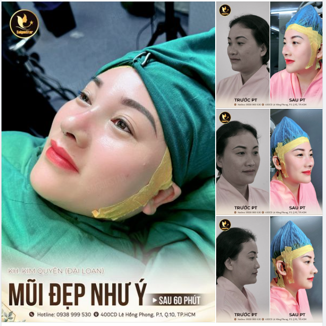 MŨI VỪA NÂNG XONG MÀ LÊN FORM CHUẨN CỠ NÀY ĐÂY Ạ