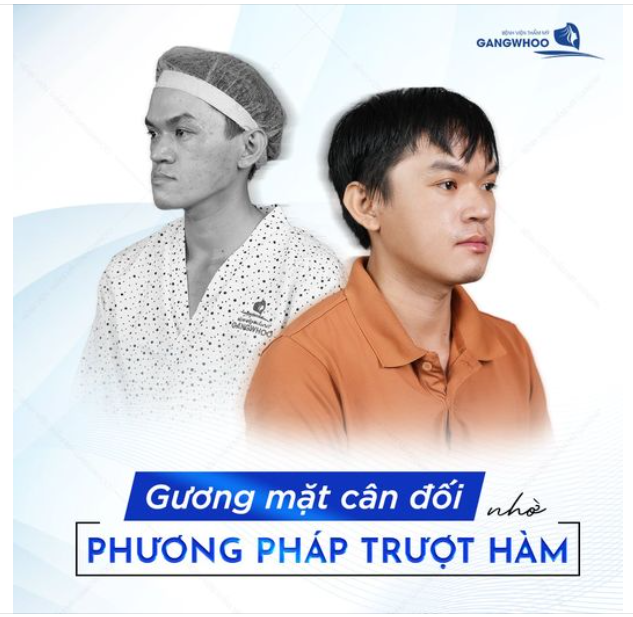 Tự ti vì ngoại hình hàm móm, vì bạn vẫn chưa biết đến trượt hàm BSSO